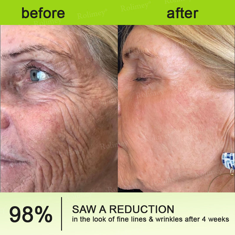 👨‍⚕️🧡Made and shipped from the USA 💫Rolimey® Botox & Vita-A Retinol Shot Wrinkle-Lift Tightening cream - Last Day Promotion 70% OFF