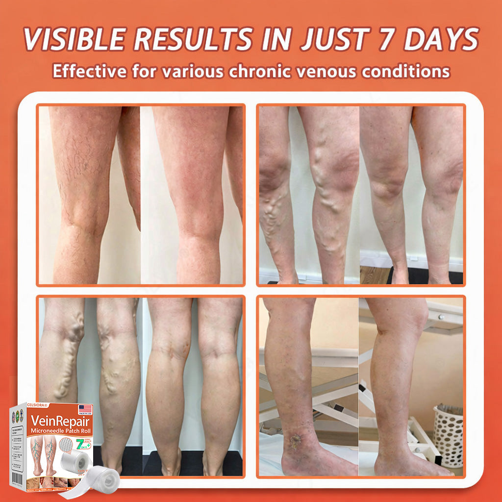 👩‍⚕️👩‍⚕️ Final Hours! Save 75% on Celsiora® Vein Ease Microneedle Care Patch(For Spider Veins, Varicose Veins, Swelling & Leg Fatigue) - Last Day Promotion 50% OFF (Copy)