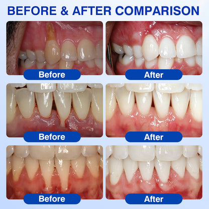 🇺🇸👨‍⚕️✅🦷Evolvion® GumRevive Periodontal Repair Gel
