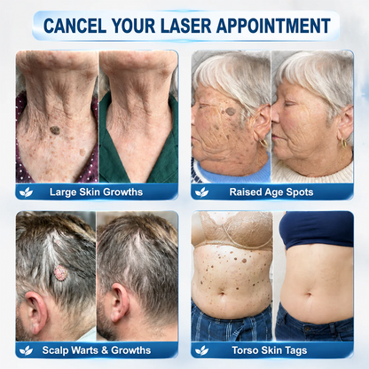 ✨Evolvion® 𝟕-𝐃𝒂𝘆 𝐒𝗸𝐢𝐧 𝐓𝒂𝗴 & 𝐒𝐩𝙤𝐭 𝐄𝐫𝒂𝐬𝙚𝐫 Painless & Scar-Free Advanced Imperfection Remova𝗜 Ro𝗜𝗜erba𝗜𝗜 Pen 🌿