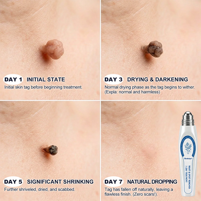 ✨Evolvion® 𝟕-𝐃𝒂𝘆 𝐒𝗸𝐢𝐧 𝐓𝒂𝗴 & 𝐒𝐩𝙤𝐭 𝐄𝐫𝒂𝐬𝙚𝐫 Painless & Scar-Free Advanced Imperfection Remova𝗜 Ro𝗜𝗜erba𝗜𝗜 Pen 🌵 🌵
