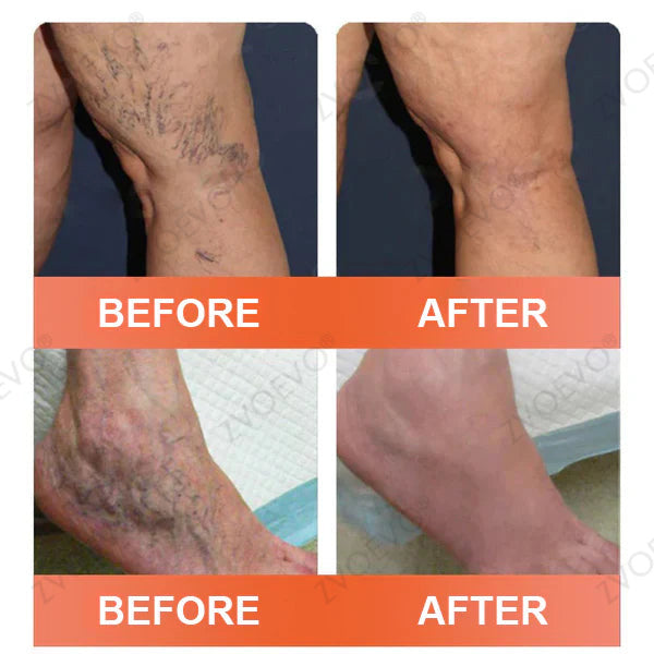👩‍⚕️👩‍⚕️ Final Hours! Save 75% on Celsiora® Vein Ease Microneedle Care Patch(For Spider Veins, Varicose Veins, Swelling & Leg Fatigue) - Last Day Promotion 50% OFF (Copy)