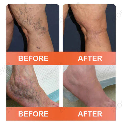 👩‍⚕️👩‍⚕️ Final Hours! Save 75% on Celsiora® Vein Ease Microneedle Care Patch(For Spider Veins, Varicose Veins, Swelling & Leg Fatigue) - Last Day Promotion 50% OFF (Copy)