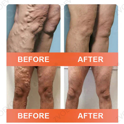 👩‍⚕️👩‍⚕️ Final Hours! Save 75% on Celsiora® Vein Ease Microneedle Care Patch(For Spider Veins, Varicose Veins, Swelling & Leg Fatigue) - Last Day Promotion 50% OFF (Copy)